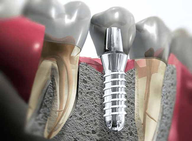 Implantologia - Studio Dentistico San Valentino
