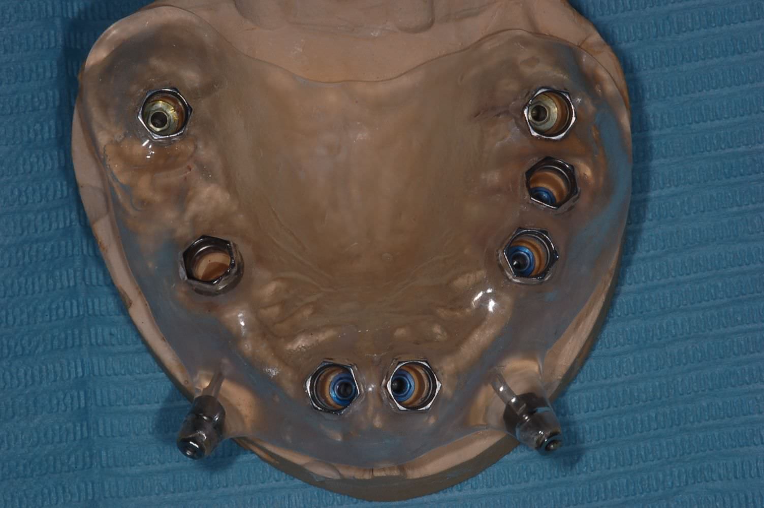 Chirurgia guidata - Studio Dentistico San Valentino